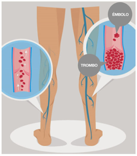Trombosis venosa profunda TVP qué es Farmalastic