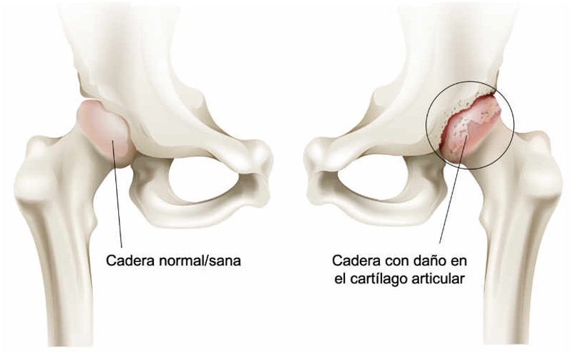 artrosis de cadera