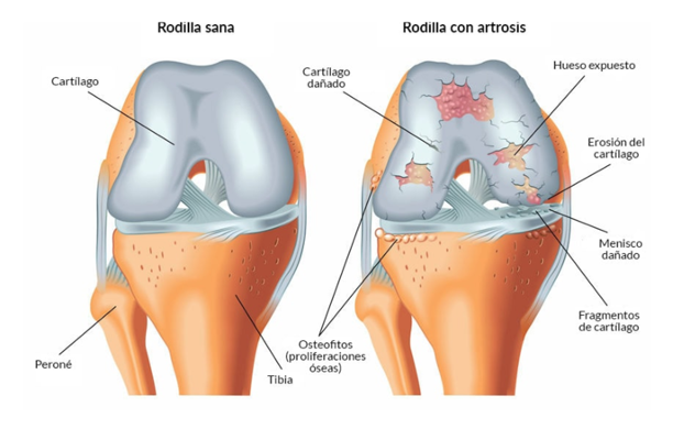 rodilla artrosis