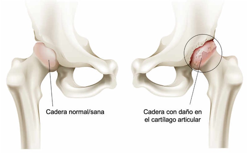 Comparación entre cadera normal y sana con cadera con daño en el cartilago articular