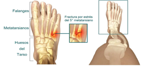 Qu Es Una Fractura Por Estr S Farmalastic