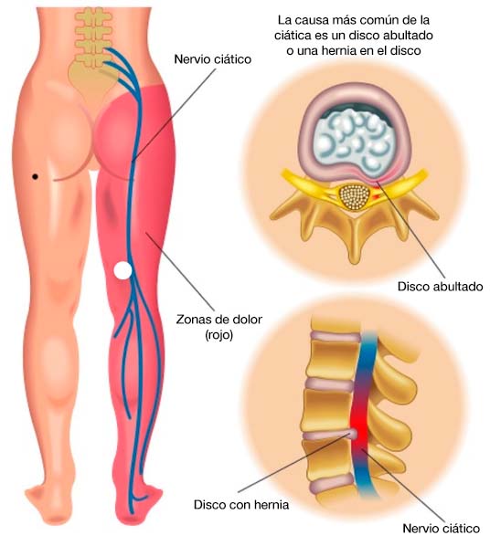 lumbociática o ciática