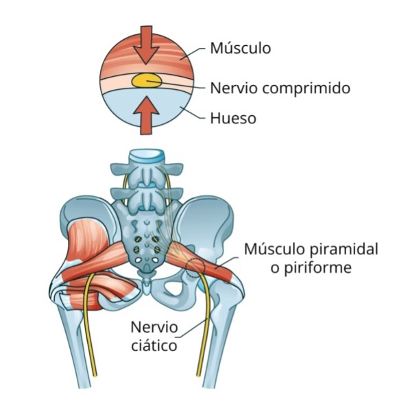 falsa ciatica