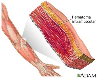 esquema hematoma intramuscular