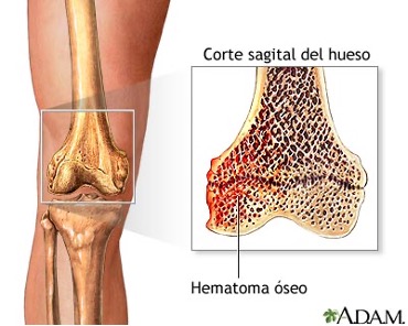 Esquema Hematoma periostico