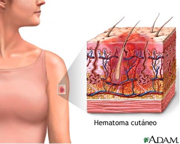 Hematoma Subcutáneo esquema