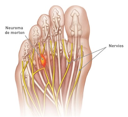 neuroma de morton