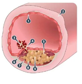 trombosis arterial